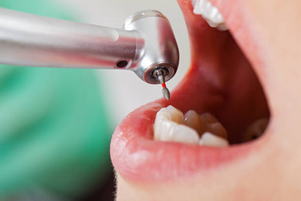 Best Dentist for Tooth Abscess  in Temelec, CA